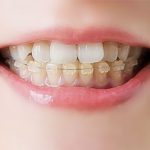 歯並びの悪さが体にもたらす影響