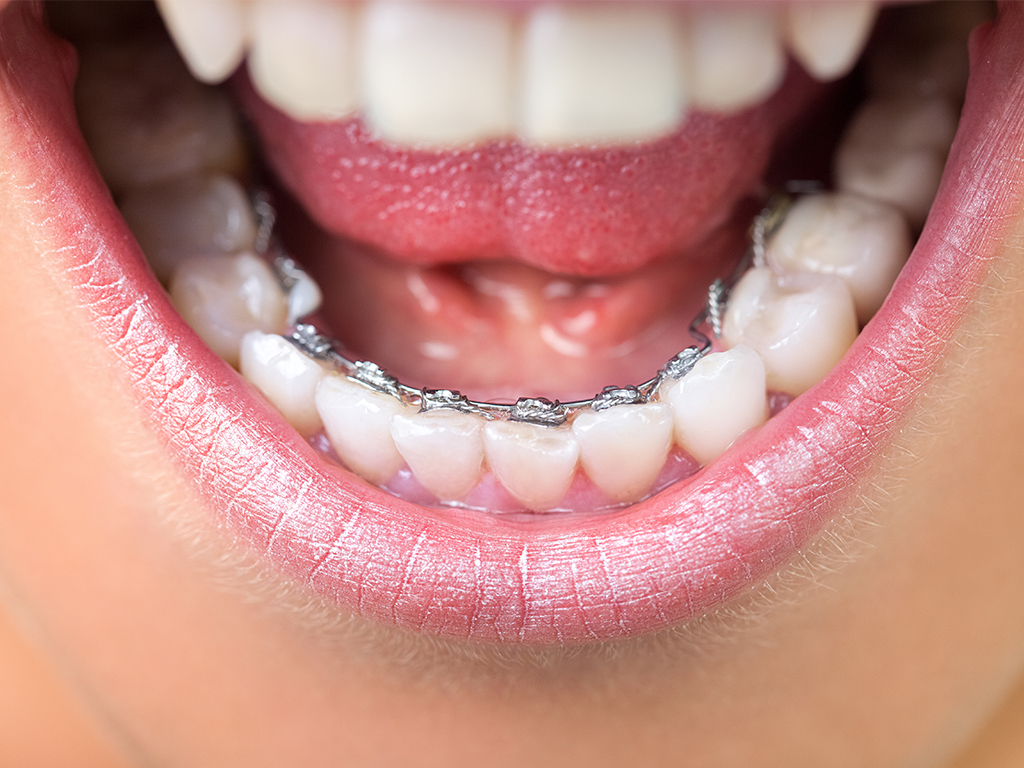 舌側矯正のメリット・デメリットについて | 彩都西歯科クリニック
