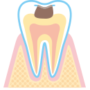 虫歯の進行C2