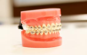 インビザライン難症例には抜歯やワイヤーを併用
